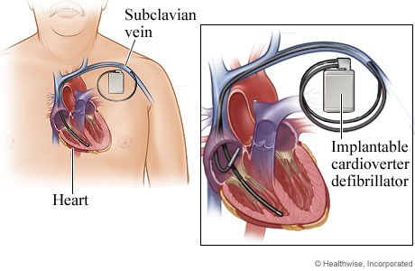 implantable cardioverter defibrillator vs pacemaker