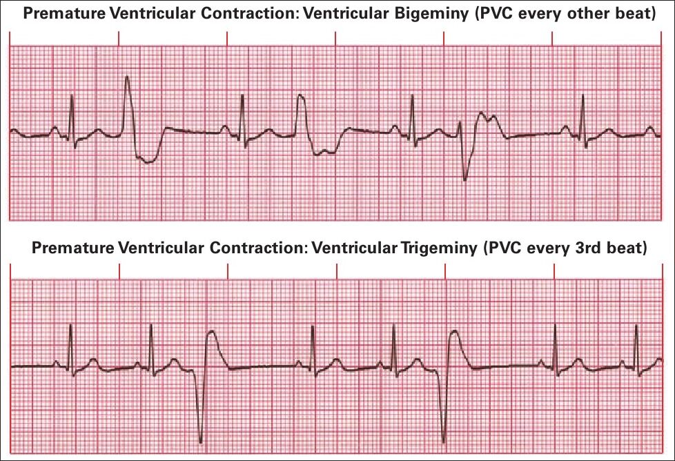 premature ventricular contraction ecg